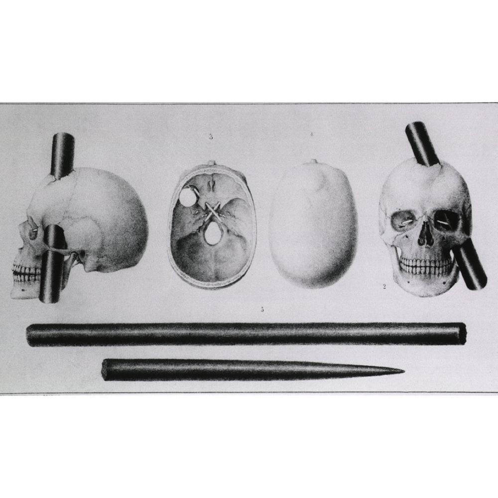 Various Views Of The Famous Wound In The Skull Of Phineas Gage History Image 1