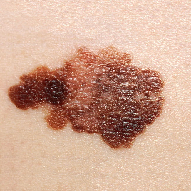 Melanoma on a patients skin Poster Print by National Institutes of Health/Stocktrek Images Image 2