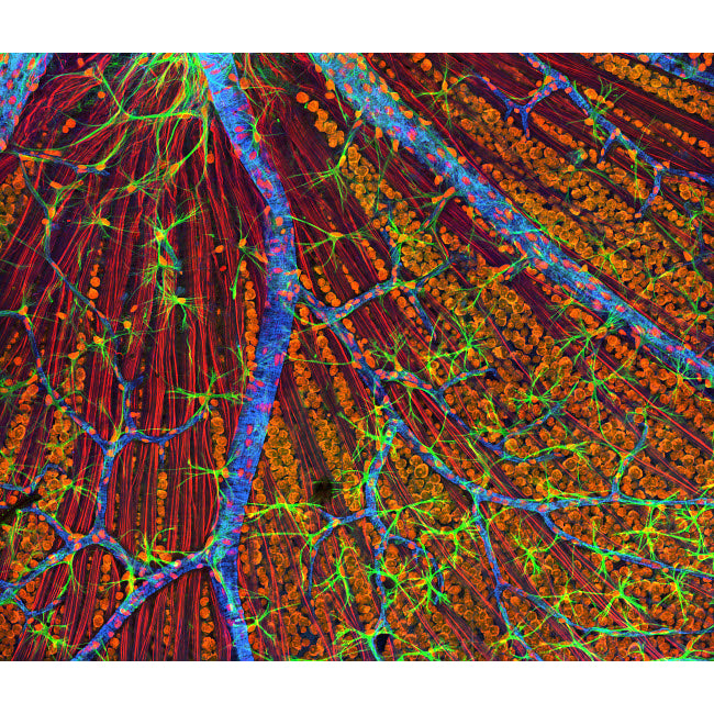 Neurofibromatosis a genetic disorder of the nervous system Poster Print by National Institutes of Health/Stocktrek Imag Image 1