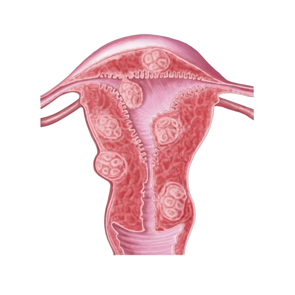 Anatomy of fibroid tumors in female uterus Poster Print Image 1