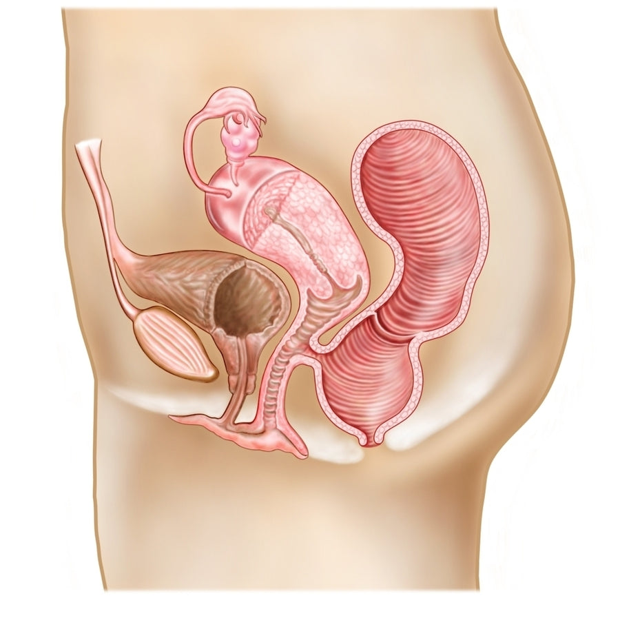 Rectovaginal fistula and cross section of female reproductive organs Poster Print Image 1