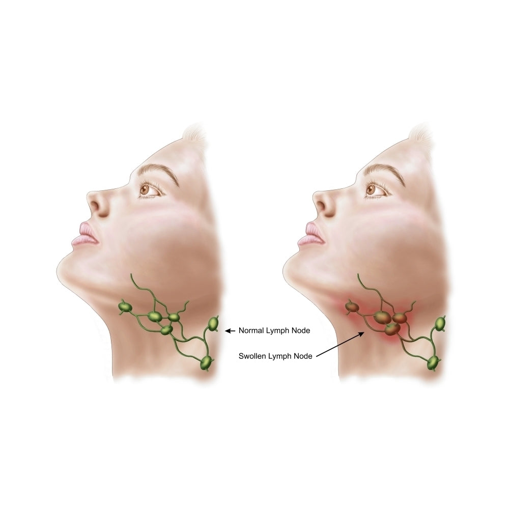 Anatomy of swollen lymph nodes Poster Print Image 1