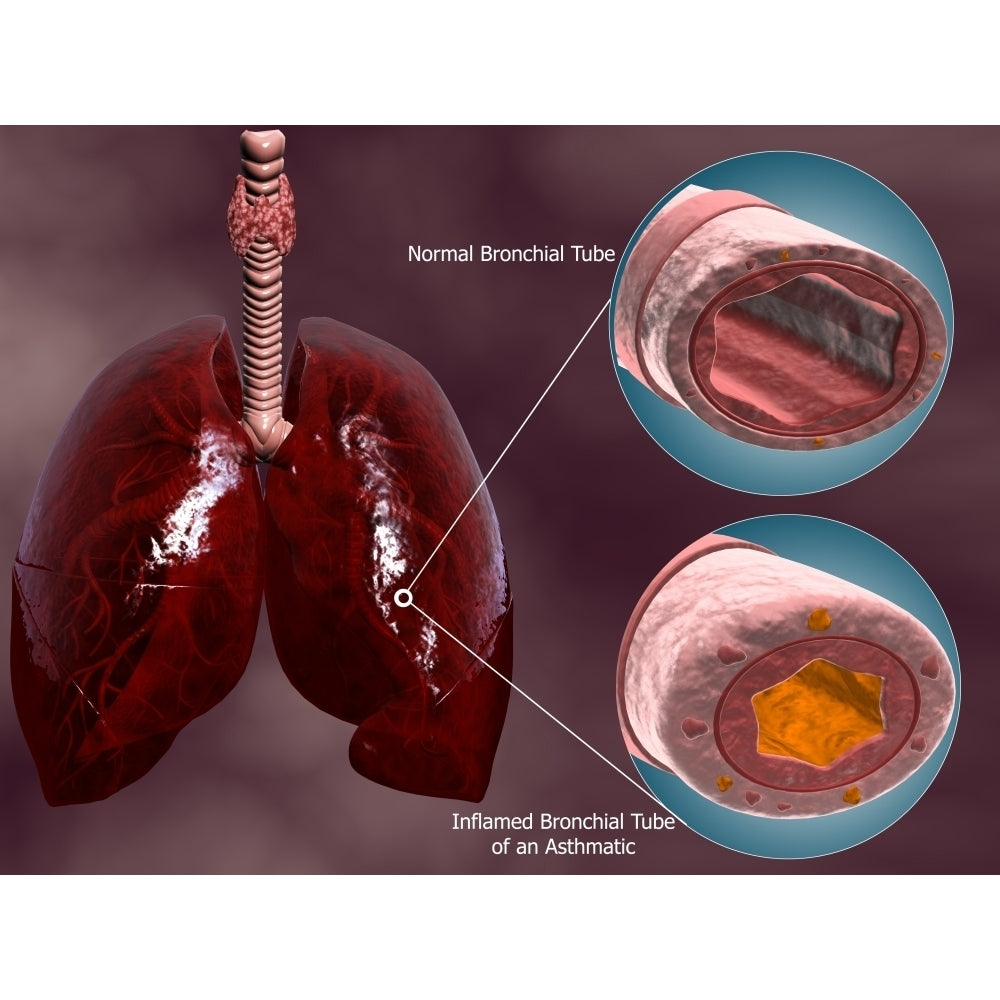 Trachea cross-section with lungs showing normal and asthmatic bronchiole Poster Print Image 1