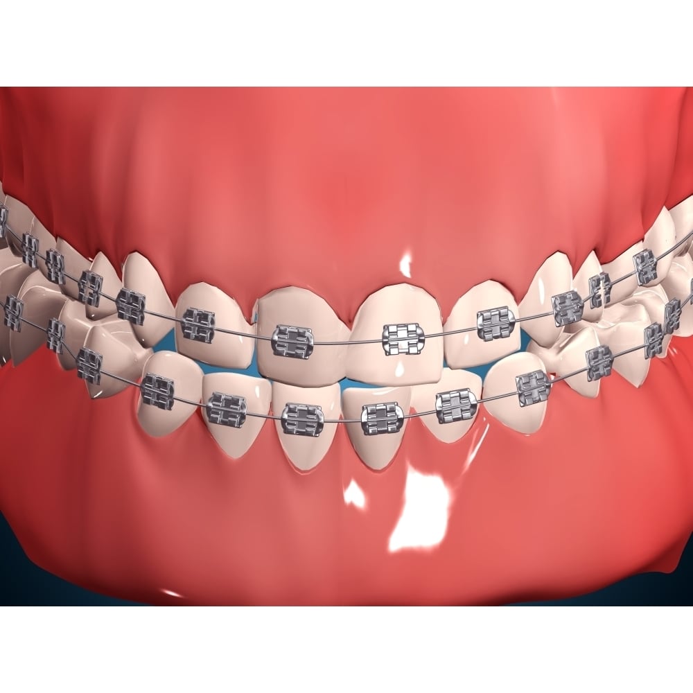 Medical illustration of human mouth showing teeth gums and metal braces Poster Print Image 2