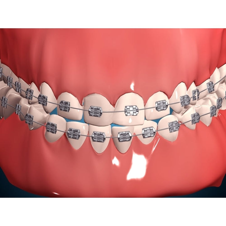 Medical illustration of human mouth showing teeth gums and metal braces Poster Print Image 1