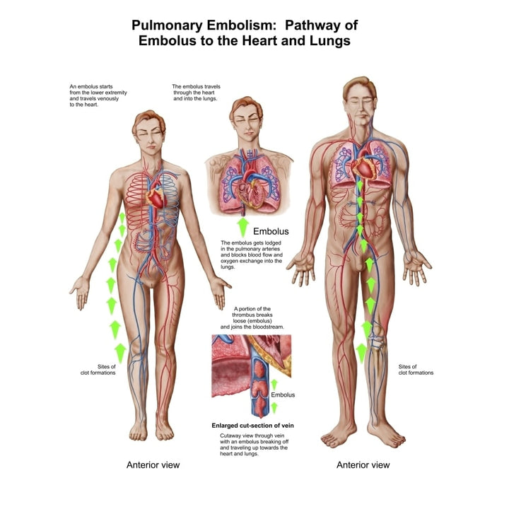 Pulmonary embolism pathway of embolus to the heart and lungs Poster Print Image 1