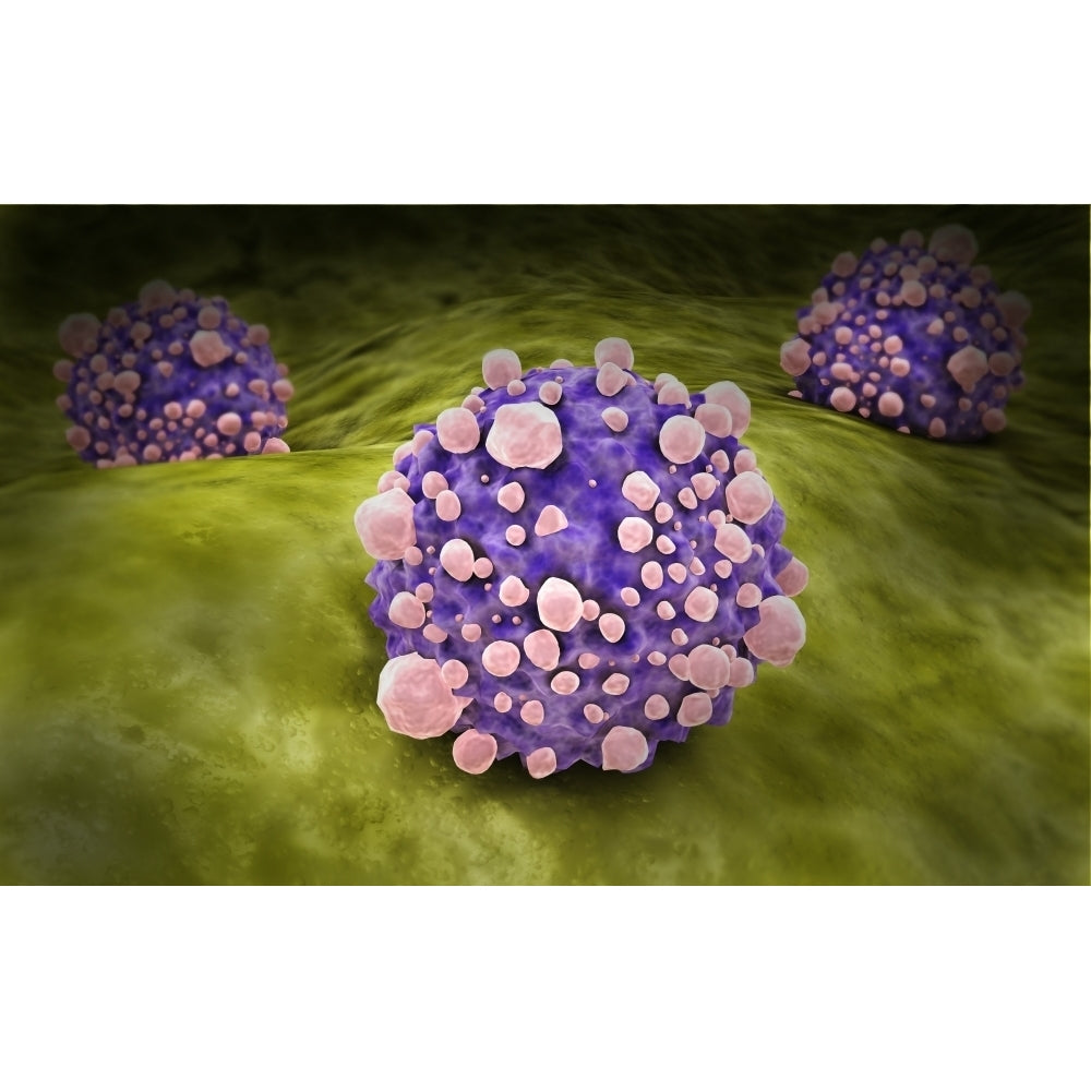 Microscipic view of pancreatic cancer cells Poster Print Image 1