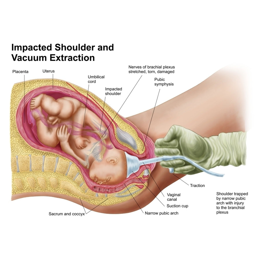 Delivery of fetus using vacuum extraction due to shoulder dystocia Poster Print Image 1