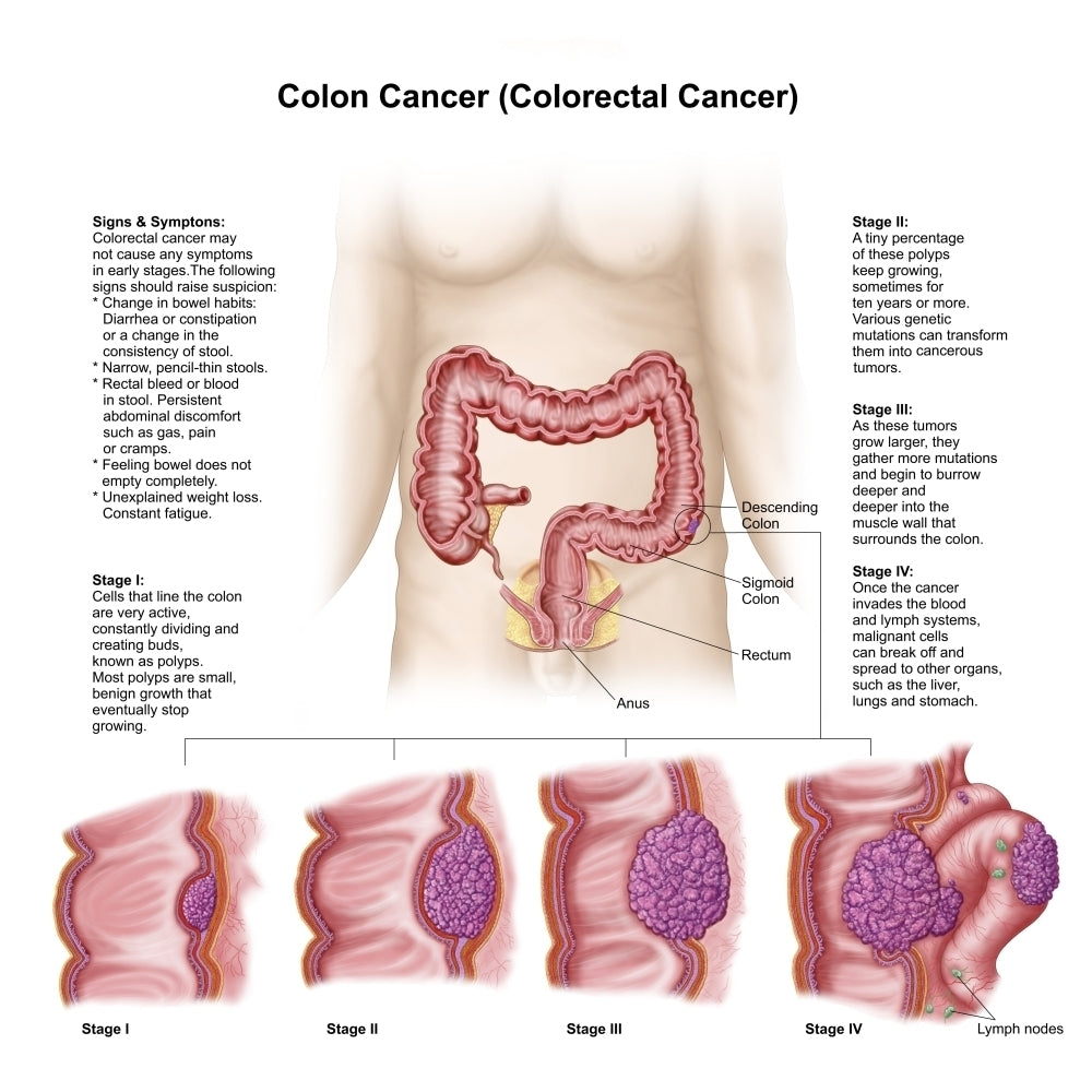 Medical illustration depicting the different stages of colon cancer Poster Print Image 1