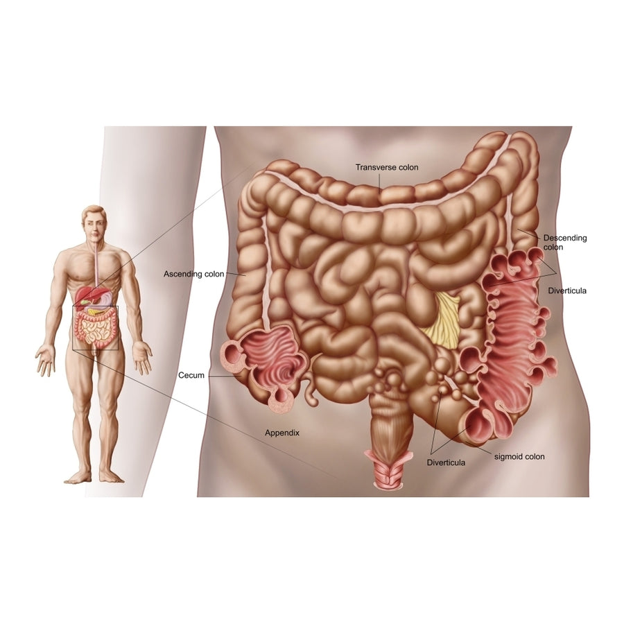 Diverticulitis in the descending colon region of the human intestine Poster Print Image 1