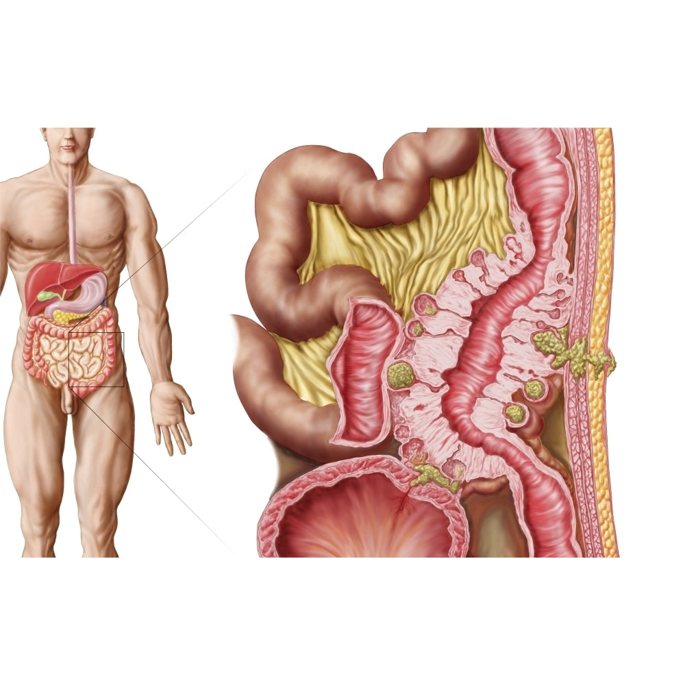 Illustration of diverticulosis in the colon Poster Print Image 1