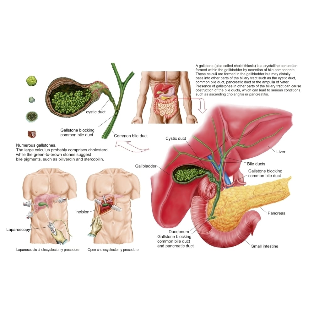 Illustration depicting cholecystectomy the surgical removal of the gallbladder Poster Print Image 1