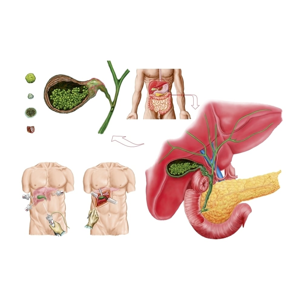 Illustration depicting cholecystectomy the surgical removal of the gallbladder Poster Print Image 1