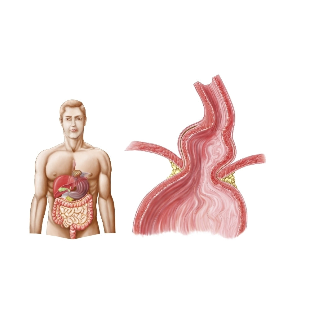 Medical ilustration of a hiatal hernia in the upper part of the stomach into the thorax Poster Print Image 2