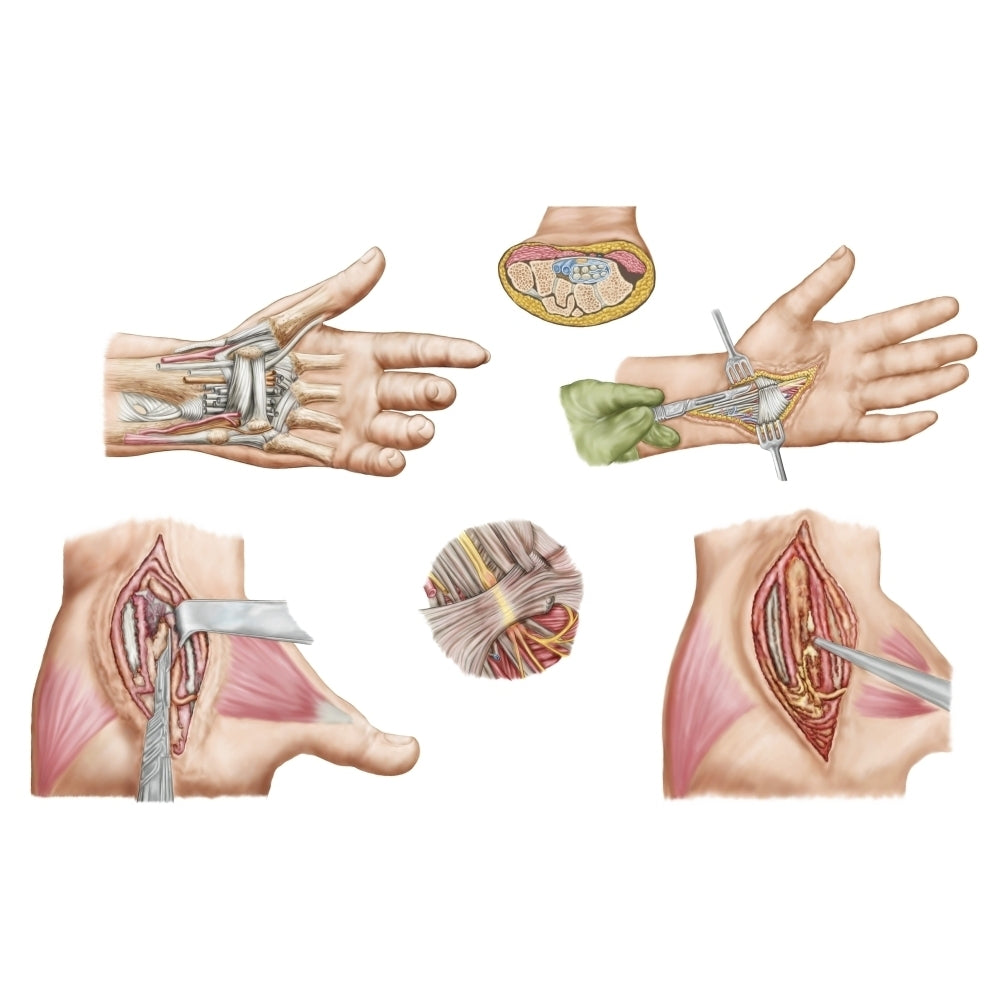 Medical illustration showing carpal tunnel syndrome in the human wrist Poster Print Image 1