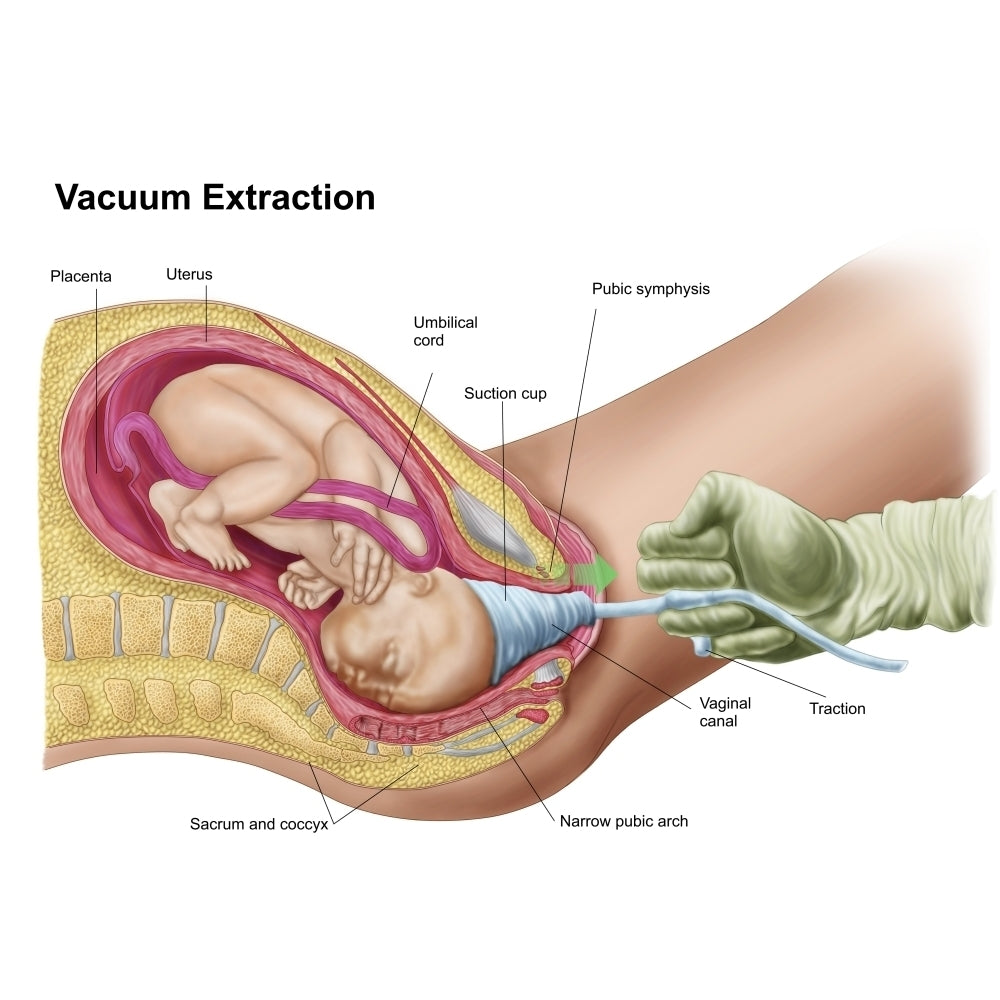 Illustration showing delivery of fetus using vacuum extraction Poster Print Image 2