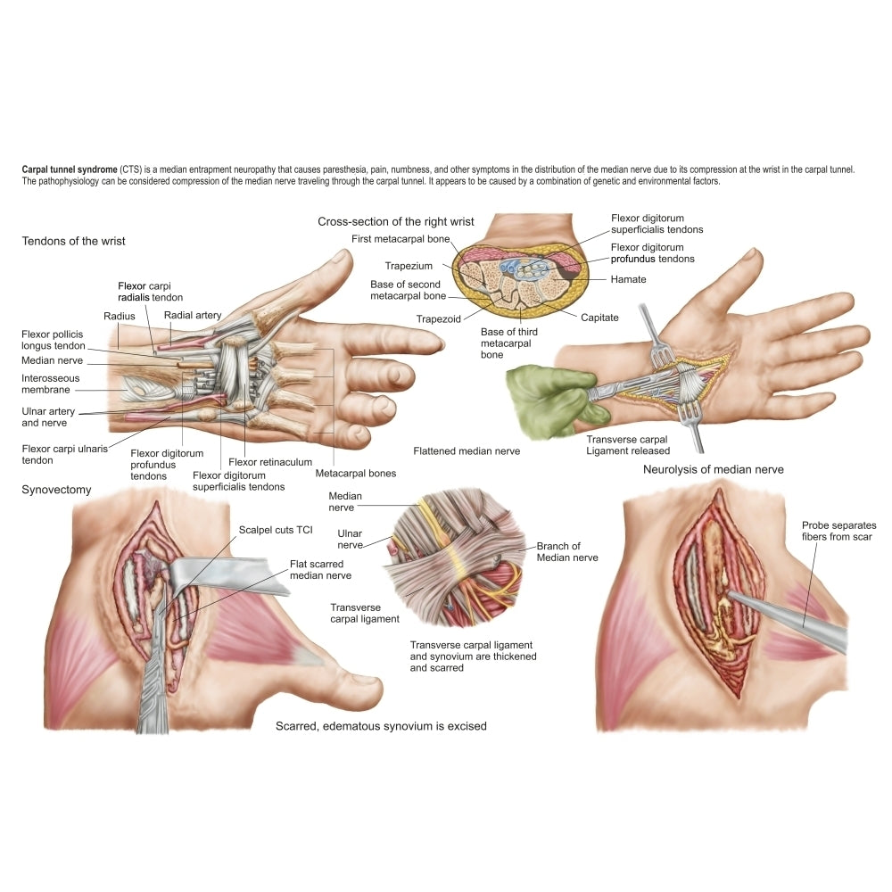 Medical illustration showing carpal tunnel syndrome in the human wrist Poster Print Image 1