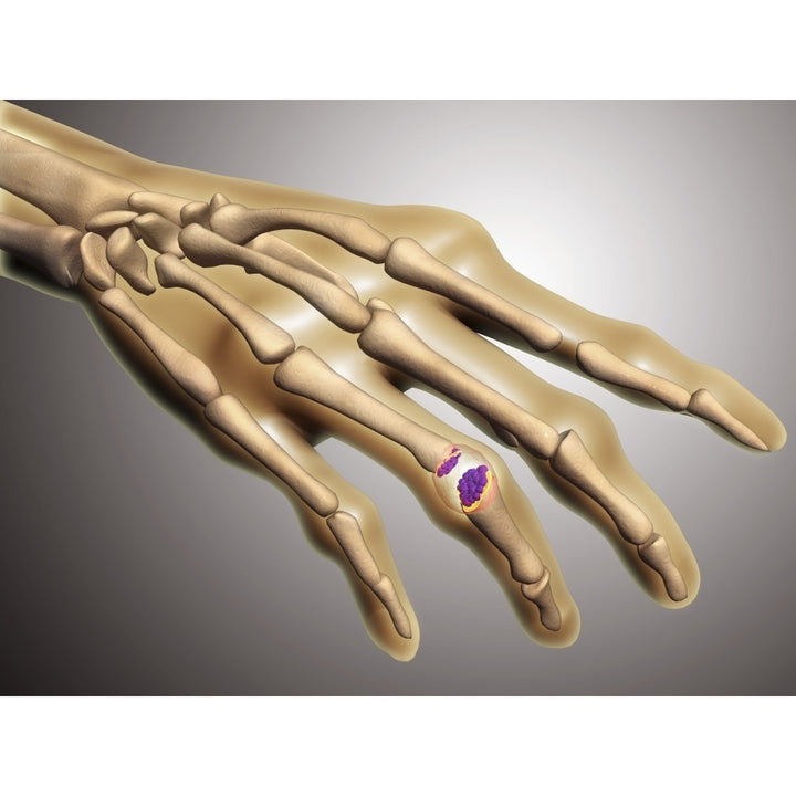 Conceptual image of rheumatoid arthritis in the human hand Poster Print Image 1