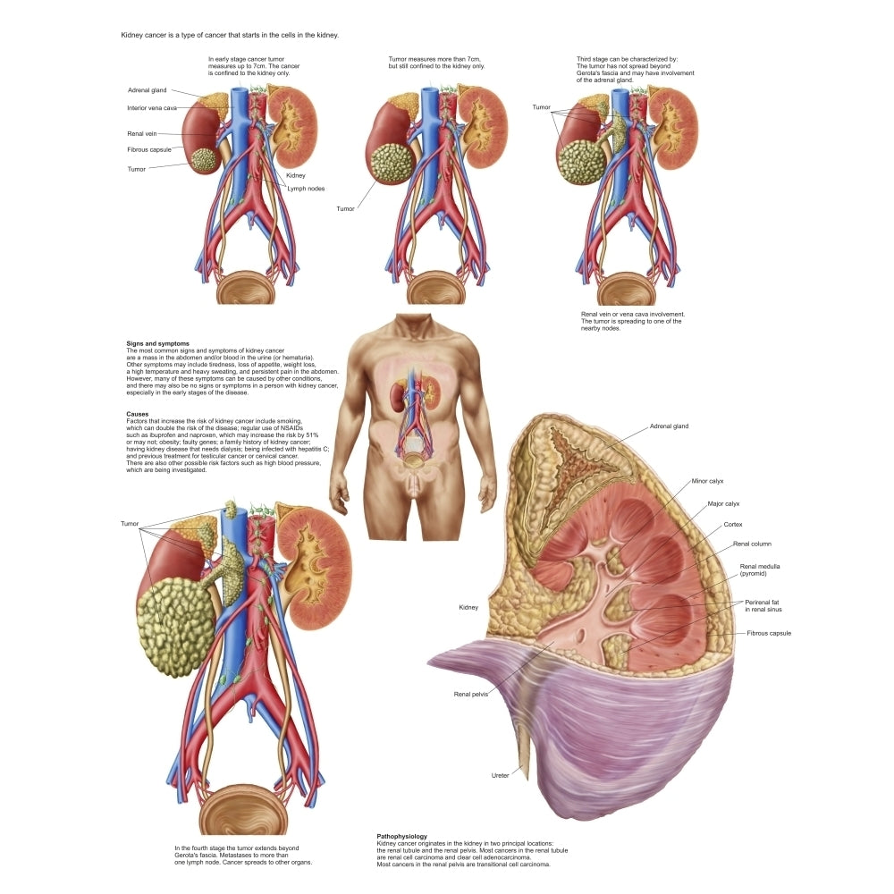 Medical chart showing the signs and symptoms of kidney cancer Poster Print Image 1