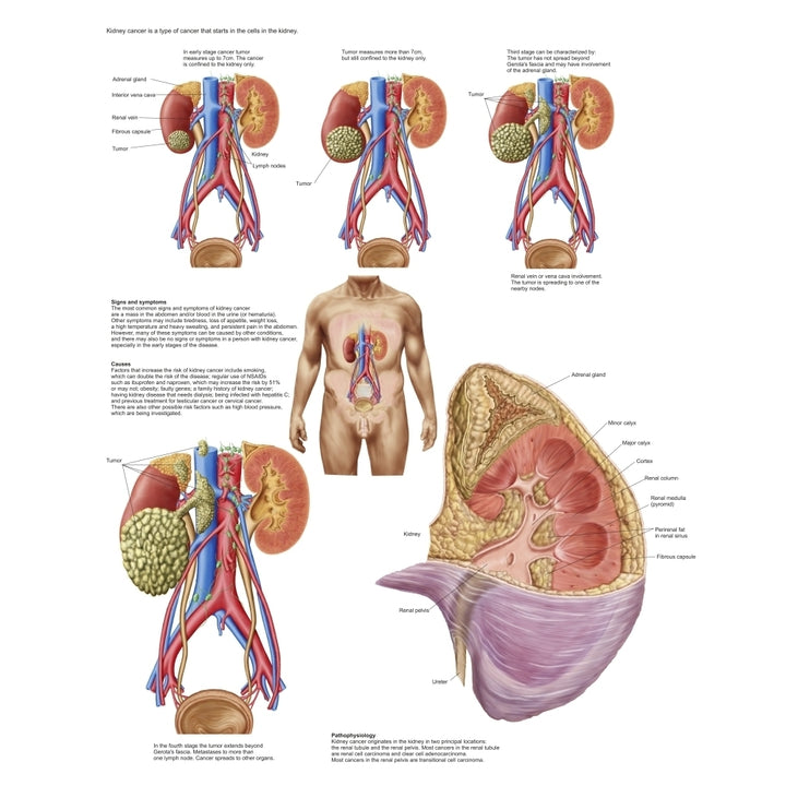 Medical chart showing the signs and symptoms of kidney cancer Poster Print Image 1