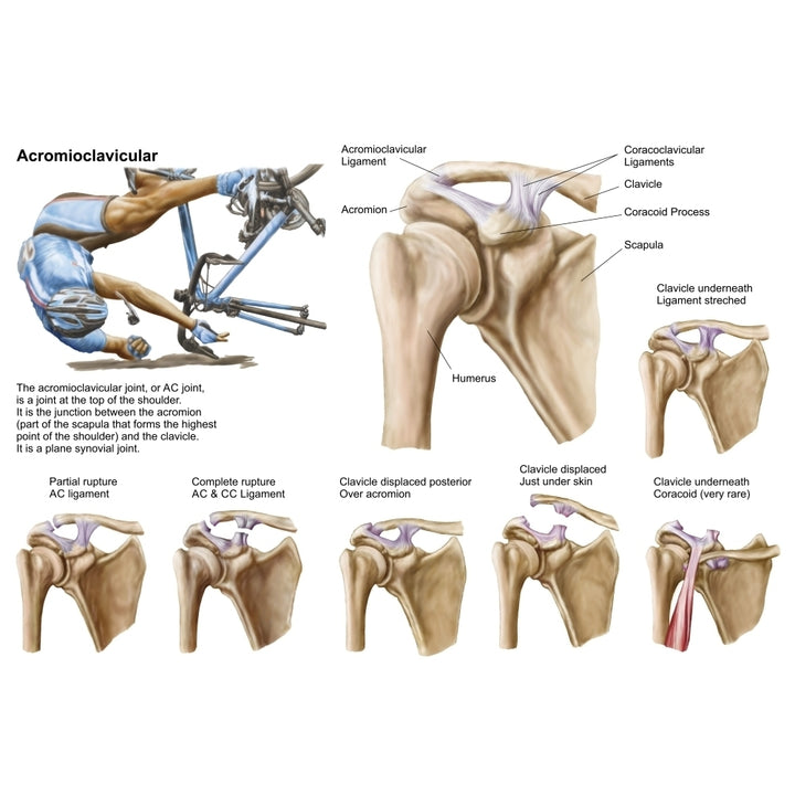 Anatomy of acromioclavicular joint rupture and displacement Poster Print Image 1