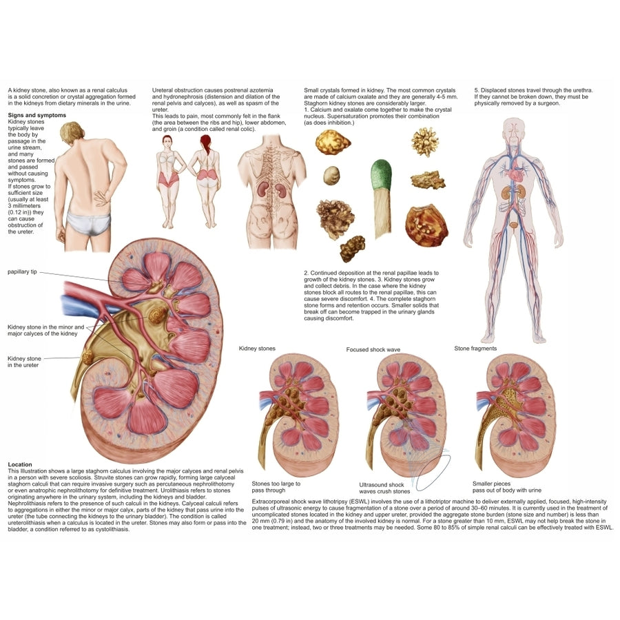 Medical chart showing the signs and symptoms of kidney stones Poster Print Image 1