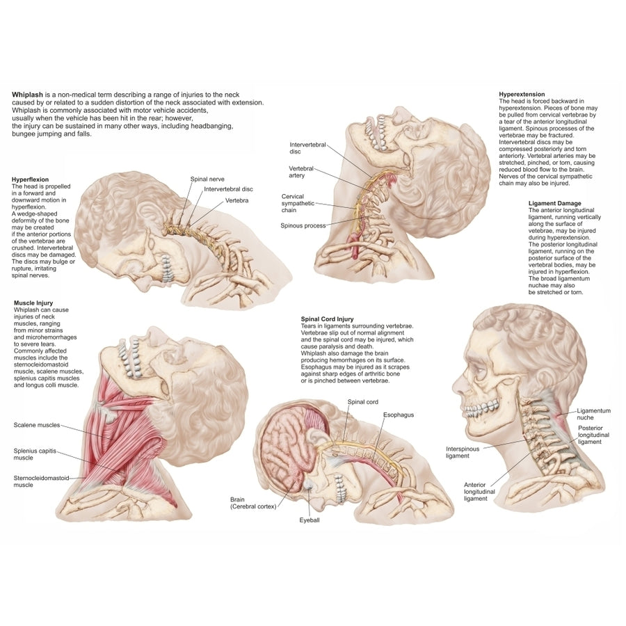 Medical chart showing the range of injuries to the human neck caused by whiplash Poster Print Image 1