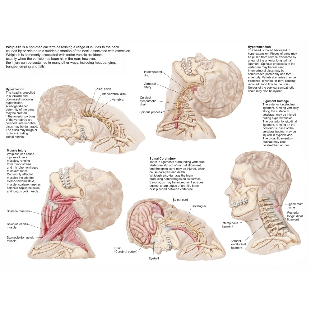 Medical chart showing the range of injuries to the human neck caused by whiplash Poster Print Image 2