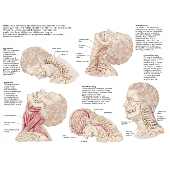 Medical chart showing the range of injuries to the human neck caused by whiplash Poster Print Image 1