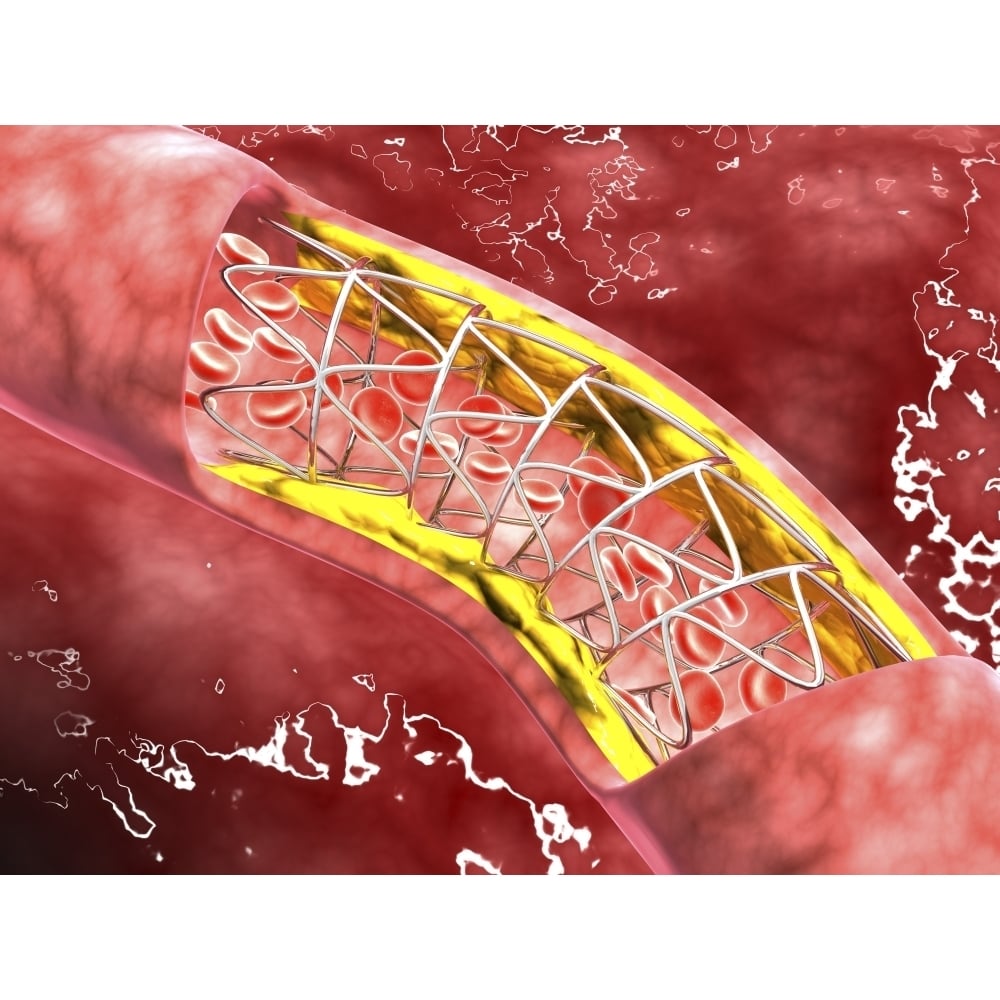 Artery cross-section with blood flow fat plaque and stent deployment Poster Print Image 2