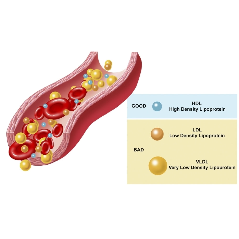 Good and bad cholesterol found in blood stream. Poster Print by TriFocal Communications/Stocktrek Images Image 2