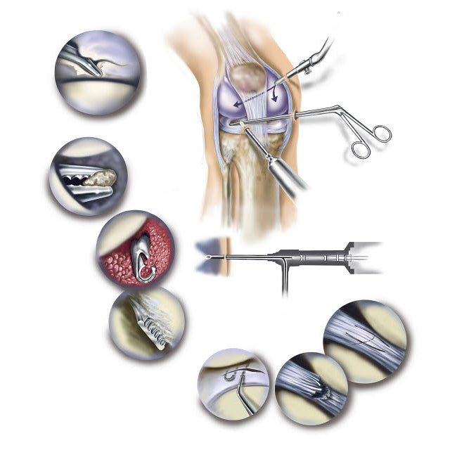 Detail of human knee showing arthroscopic surgical proceedures Poster Print by TriFocal Communications/Stocktrek Images Image 1