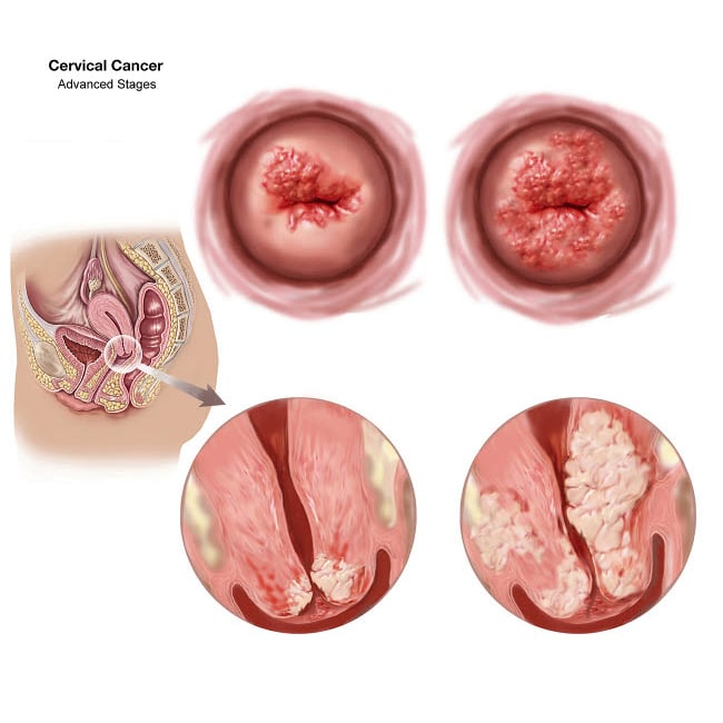 Sagittal view and vaginal view of advanced cervical cancer Poster Print by TriFocal Communications/Stocktrek Images Image 1