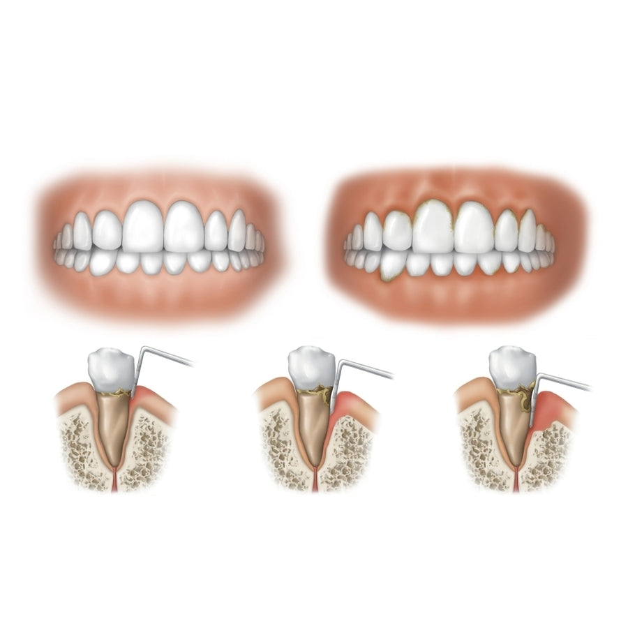 Three stages of periodontal disease. Poster Print by TriFocal Communications/Stocktrek Images Image 1