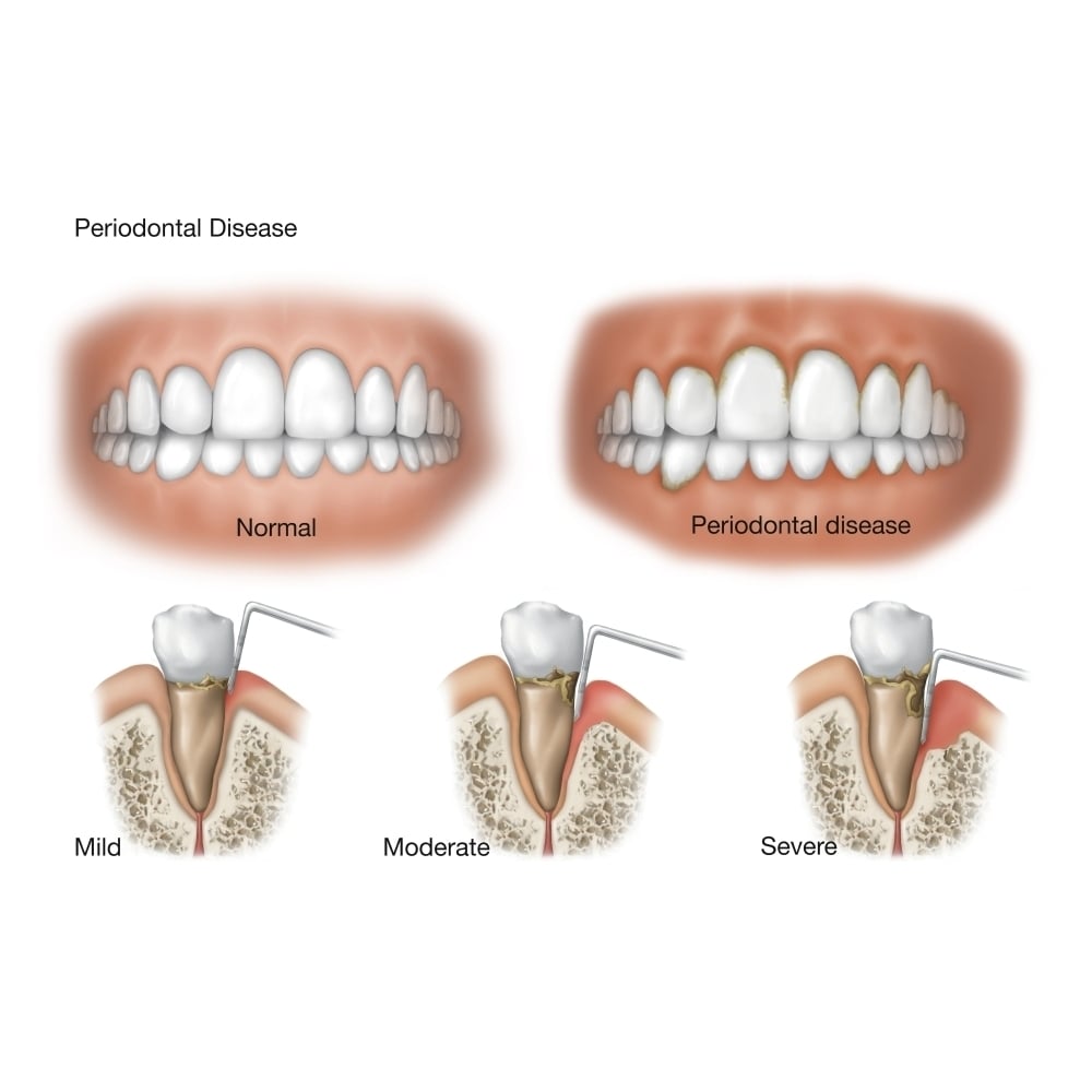 Three stages of periodontal disease. Poster Print by TriFocal Communications/Stocktrek Images Image 1