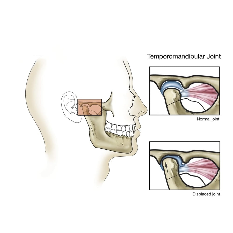 Temporomandibular joint normal and dislocated. Poster Print by TriFocal Communications/Stocktrek Images Image 1