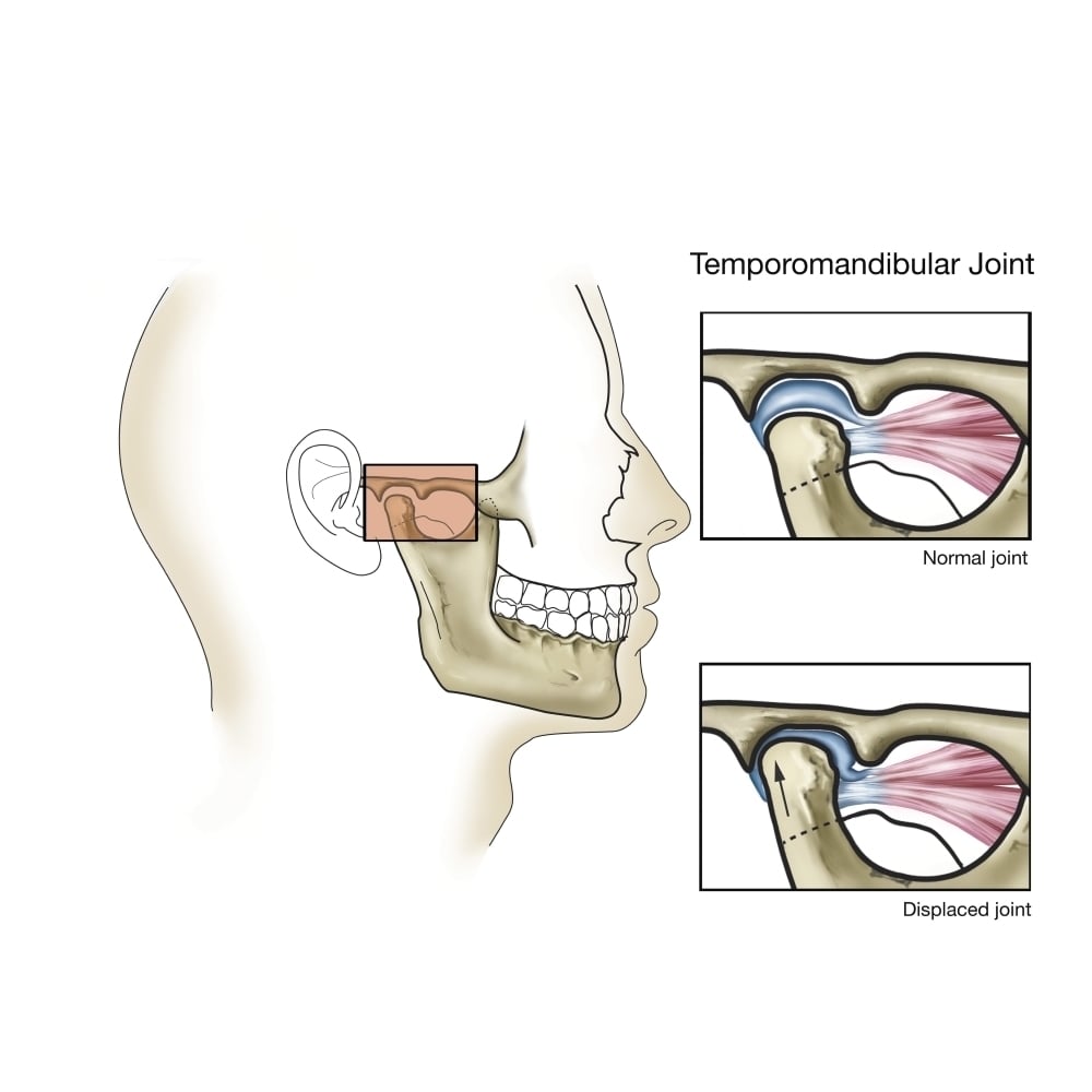 Temporomandibular joint normal and dislocated. Poster Print by TriFocal Communications/Stocktrek Images Image 2