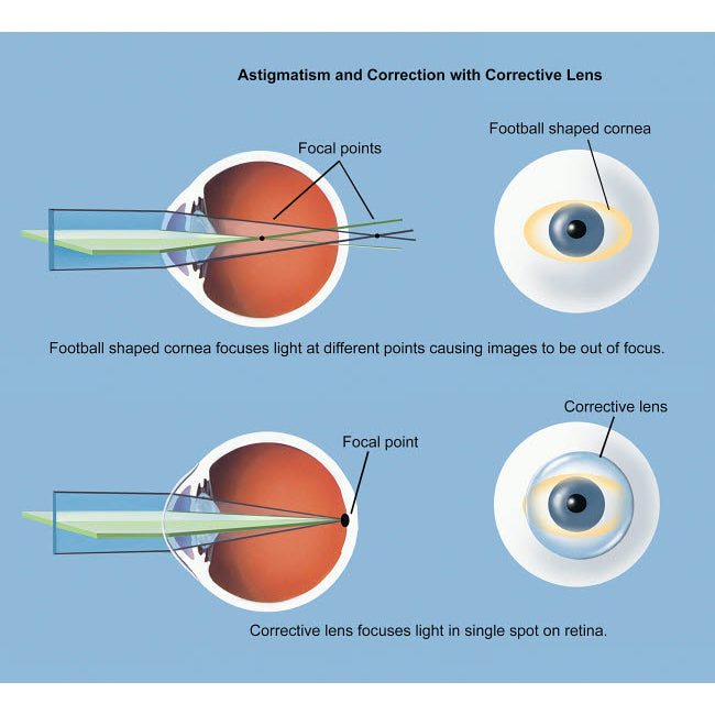 Astigmatism and correction with corrective lens Poster Print by TriFocal Communications/Stocktrek Images Image 1