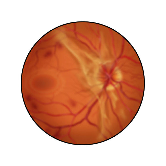 Retina with advanced diabetic retinopathy Poster Print by TriFocal Communications/Stocktrek Images Image 1