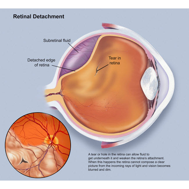 Diagram of a retinal detachment Poster Print by TriFocal Communications/Stocktrek Images Image 2