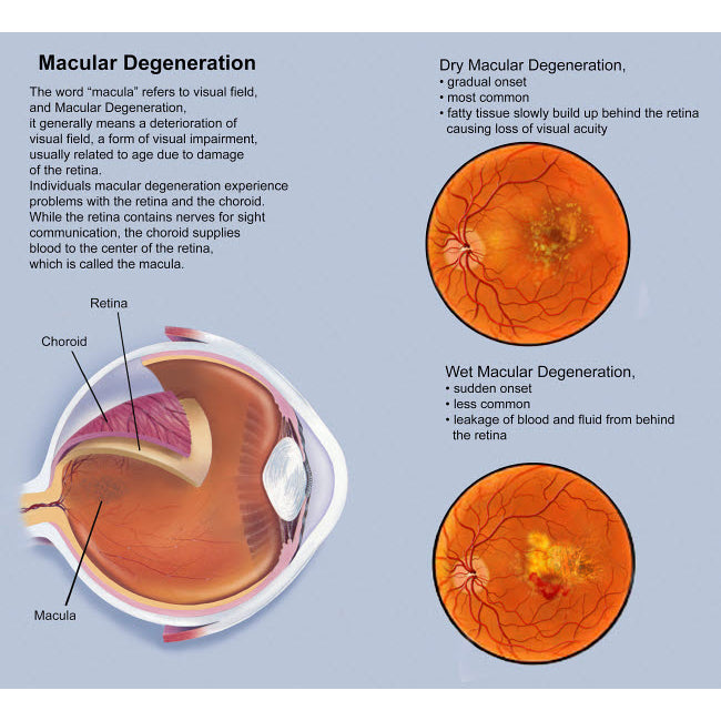 Retina with macular degeneration Poster Print by TriFocal Communications/Stocktrek Images Image 1